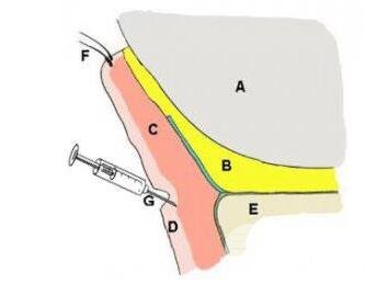 适合做玻尿酸填充的泪沟类型