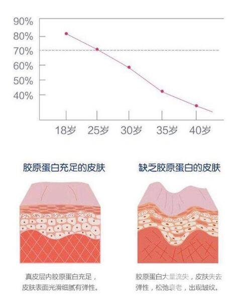 适合做玻尿酸填充的泪沟类型