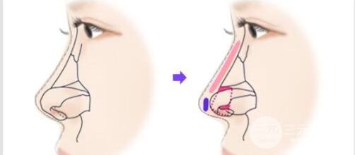 朝天鼻整形手术原理