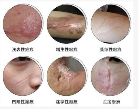 微晶磨削去疤痕优点