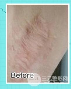 微晶磨削去疤痕注意事项