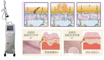 微晶磨削去疤痕原理