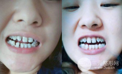 北大口腔30岁牙齿稀疏矫正过程