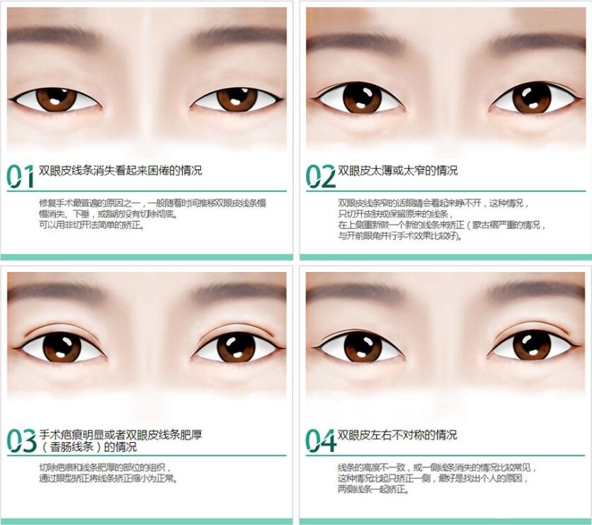 双眼皮手术后遗症