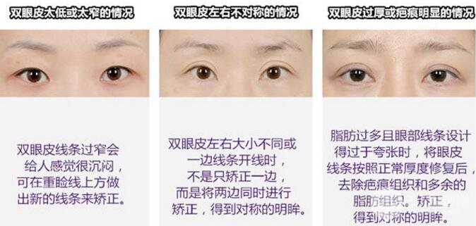 双眼皮手术修复