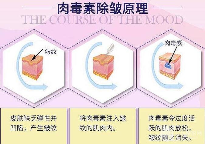 注射除皱