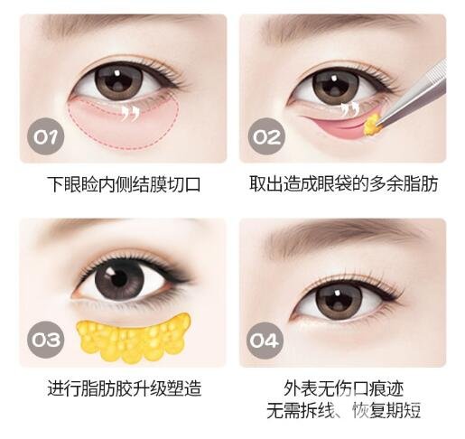 眼袋失败修复科普
