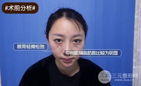 眼袋失败修复的原则