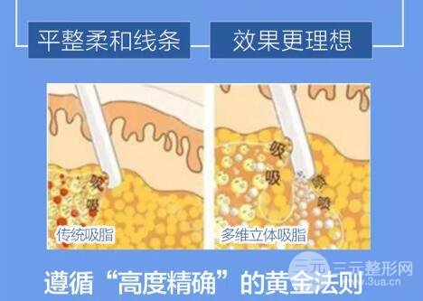 什么是吸脂手术?