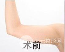 吸脂手术术后保养