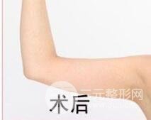 吸脂手术术后保养