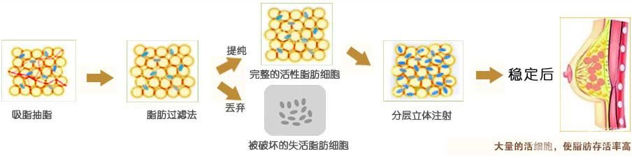 填充隆乳手术