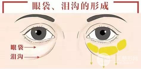 玻尿酸泪沟