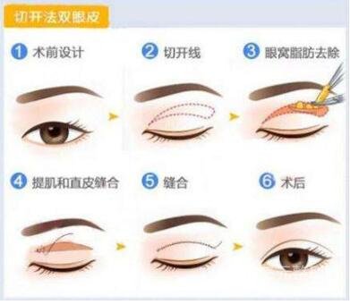 什么是双眼皮手术?