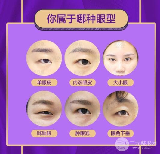 微创全切双眼皮的优缺点