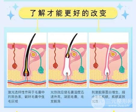 冰点脱毛的原理