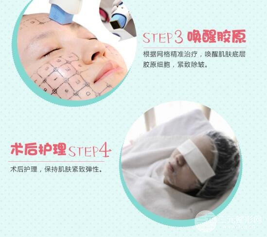 热玛吉紧肤除皱有副作用吗？