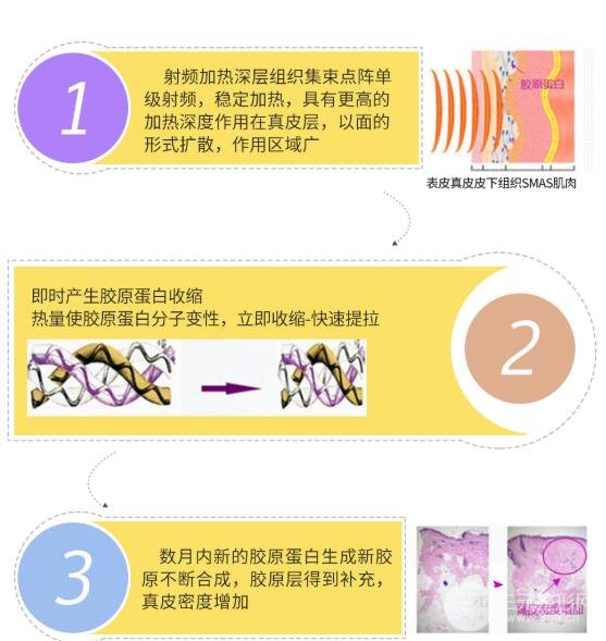什么是热玛吉除皱?