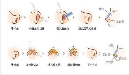 鼻翼缺损矫正手术多少钱?手术三步骤,提前揭秘~