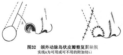 鼻翼缺损矫正手术多少钱?手术三步骤,提前揭秘~