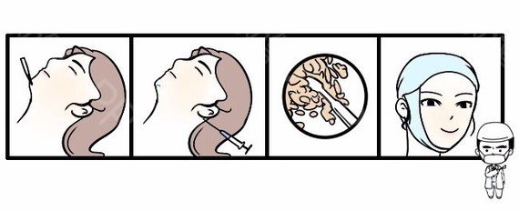抽脂瘦脸手术