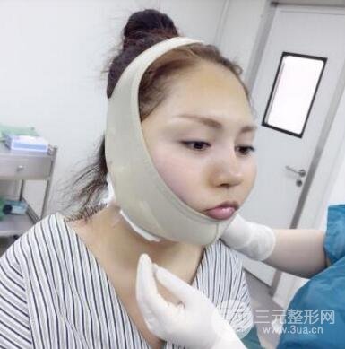 抽脂瘦脸手术果