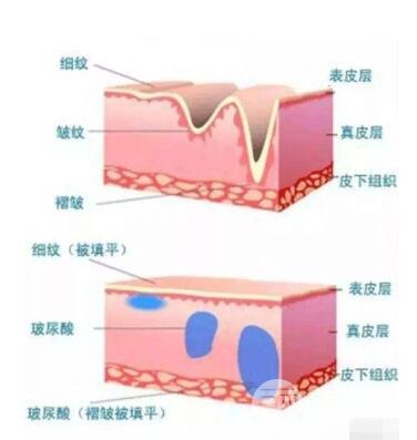 非手术拉皮除皱