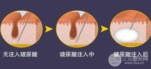 玻尿酸丰唇术后护理