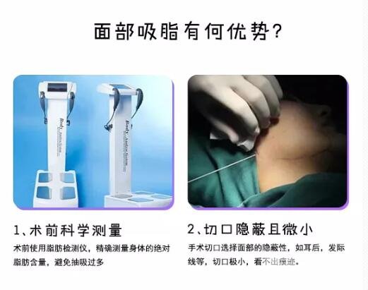 面部吸脂整形头套要戴多久?