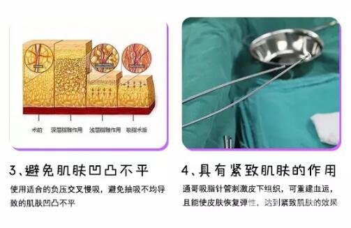 面部吸脂整形头套要戴多久?