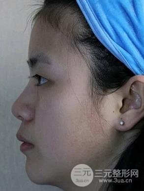 闺蜜在北京大学第三医院割双眼皮，术后果炒鸡自然~