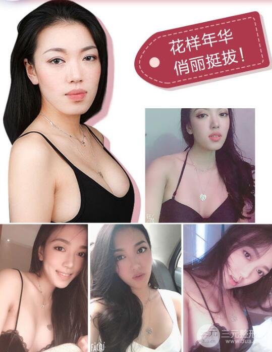 美国麦格假体隆胸果图