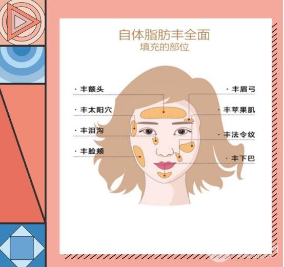 自体脂肪填充面颊保持时间?