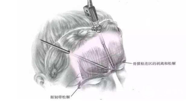 内窥镜除皱原理