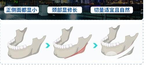 下颌角磨骨恢复时间?