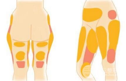 大腿内侧吸脂手术原理