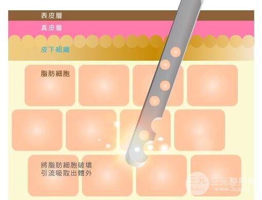 什么是背部吸脂手术呢?