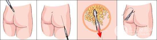 臀部吸脂手术