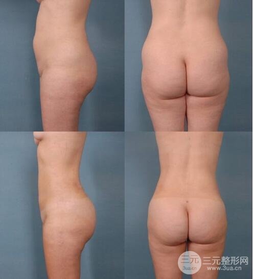臀部吸脂手术果图