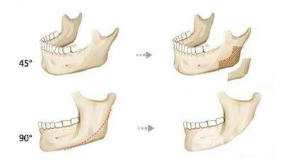 磨骨瘦脸疼不疼?