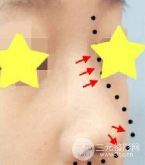 膨体隆鼻降低风险吗?