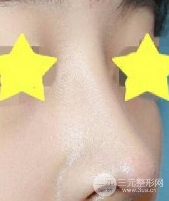 膨体隆鼻降低风险吗?