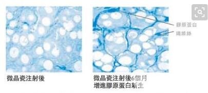 Radiesse隆鼻后注意事项?