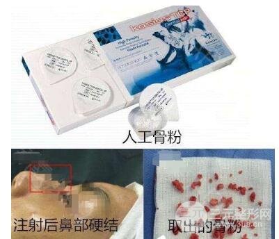 人工骨粉隆鼻的果?