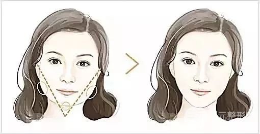 港真!激光溶脂瘦脸会反弹吗?怎么做可以避免?