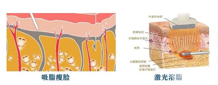 港真!激光溶脂瘦脸会反弹吗?怎么做可以避免?