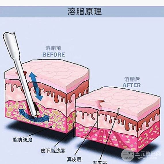 光纤溶脂好不好?果图对比惊艳了!