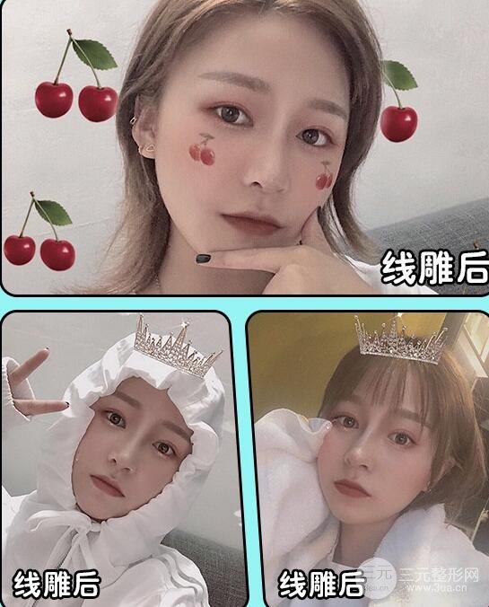 雷达埋线除皱果图