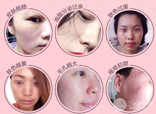 推荐做黑脸娃娃去斑吗?