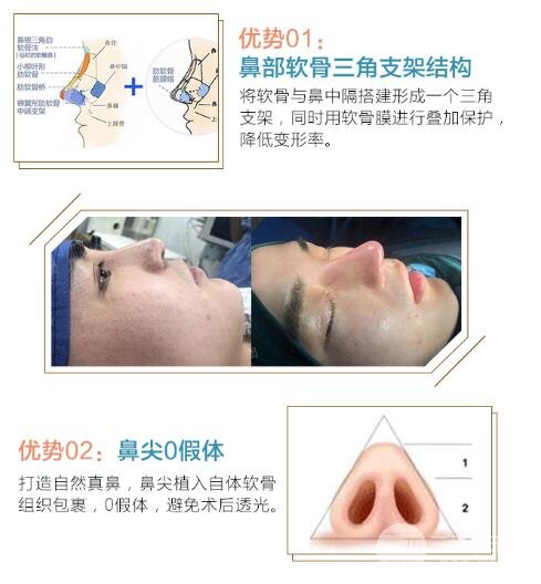耳骨隆鼻的副作用?
